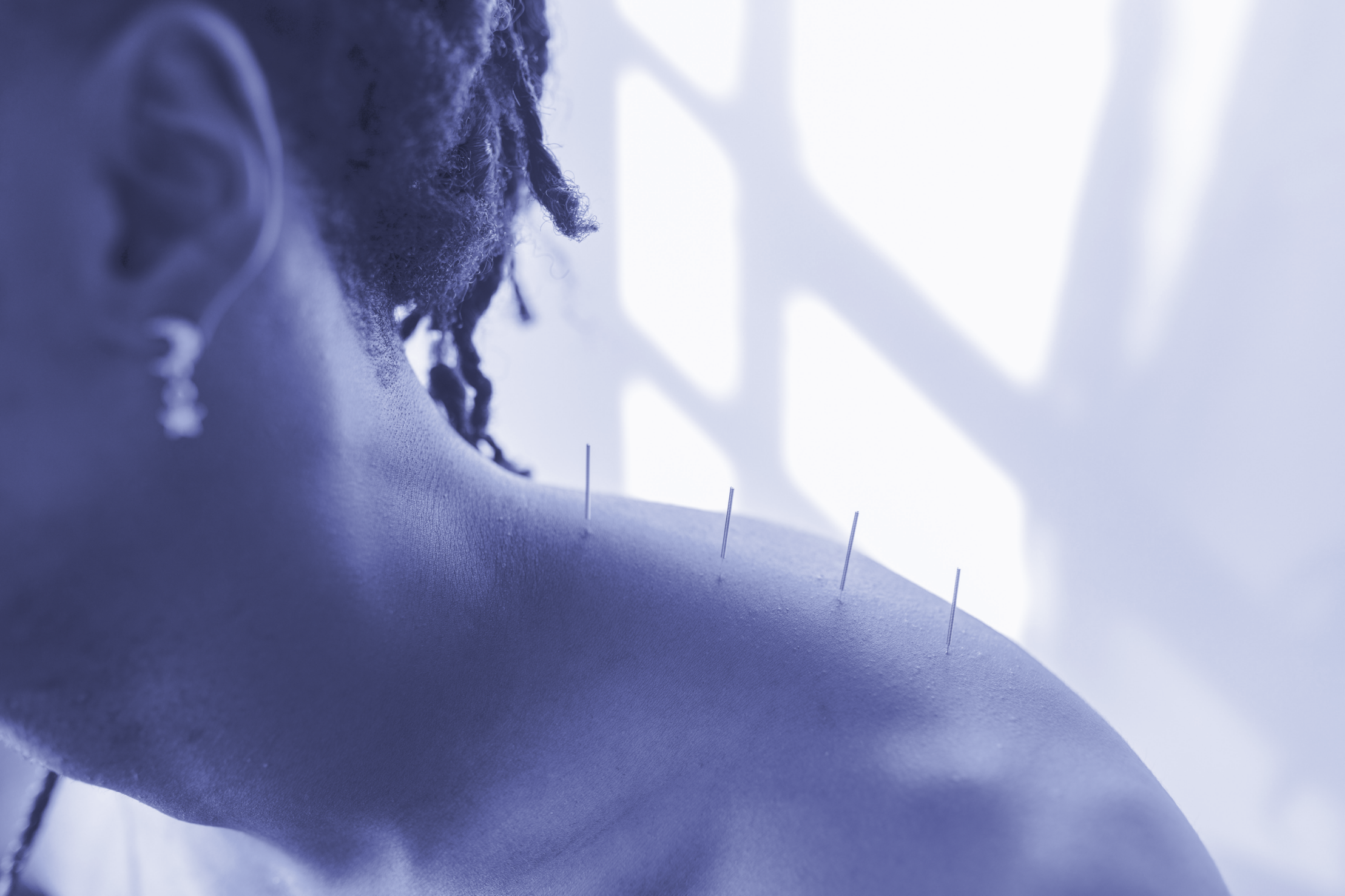 Dry needling therapy illustration